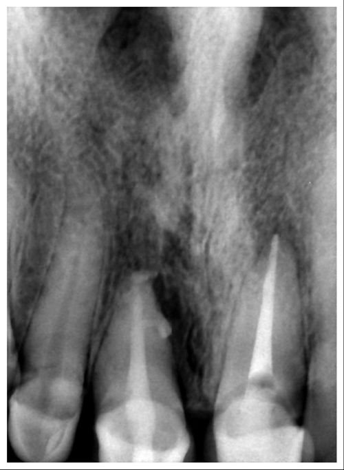 Периодонтит зуба | Стоматологическая клиника, профессиональное лечение зубов | Лечение зубов | Стоматолог Киев 